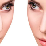 how to get rhinoplasty covered by insurance